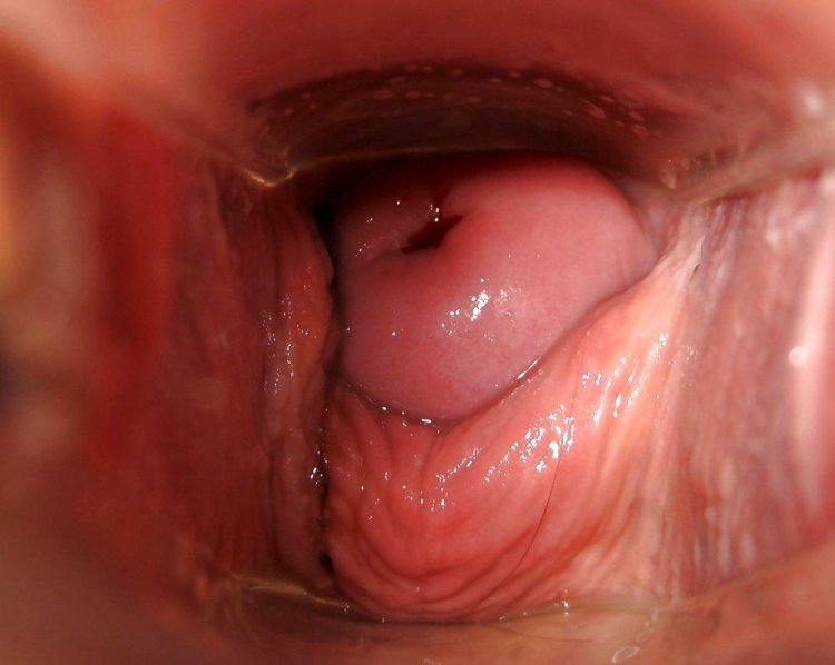 Расширитель в женской вагине