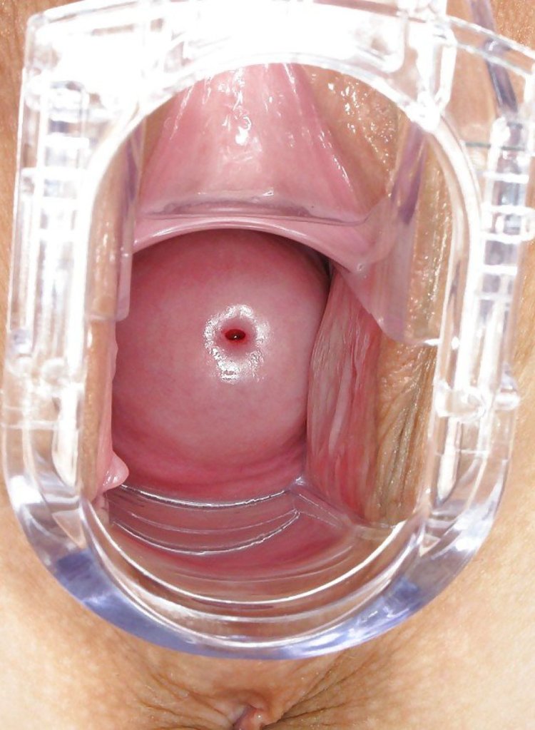 Вывернутые стенки влагалища