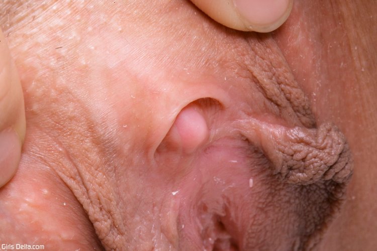 Остроконечные кондиломы вульвы