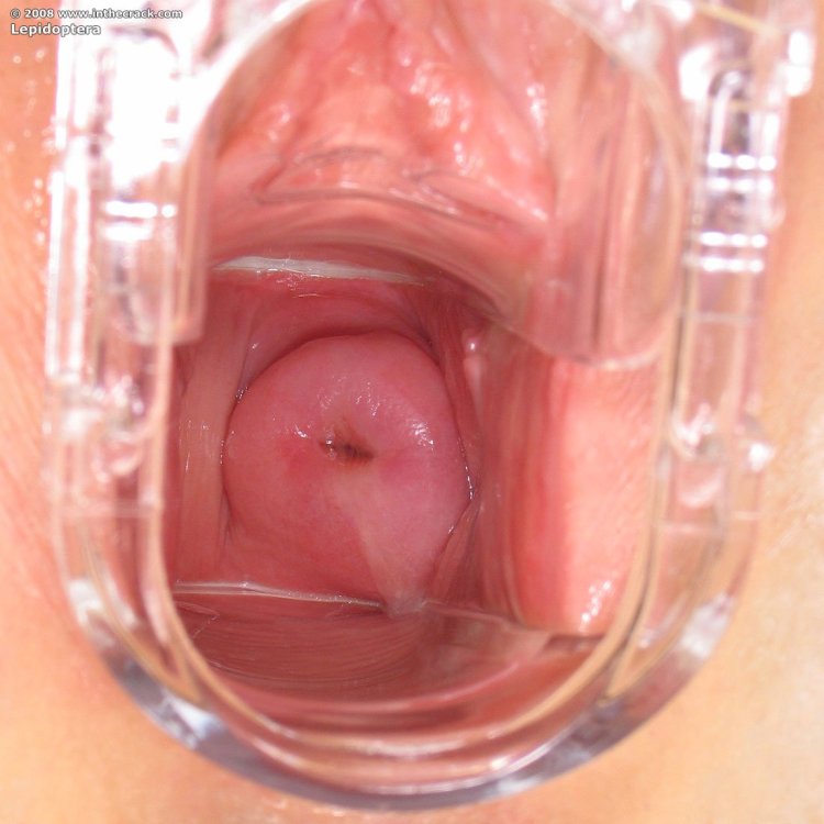 Здоровая шейка матки