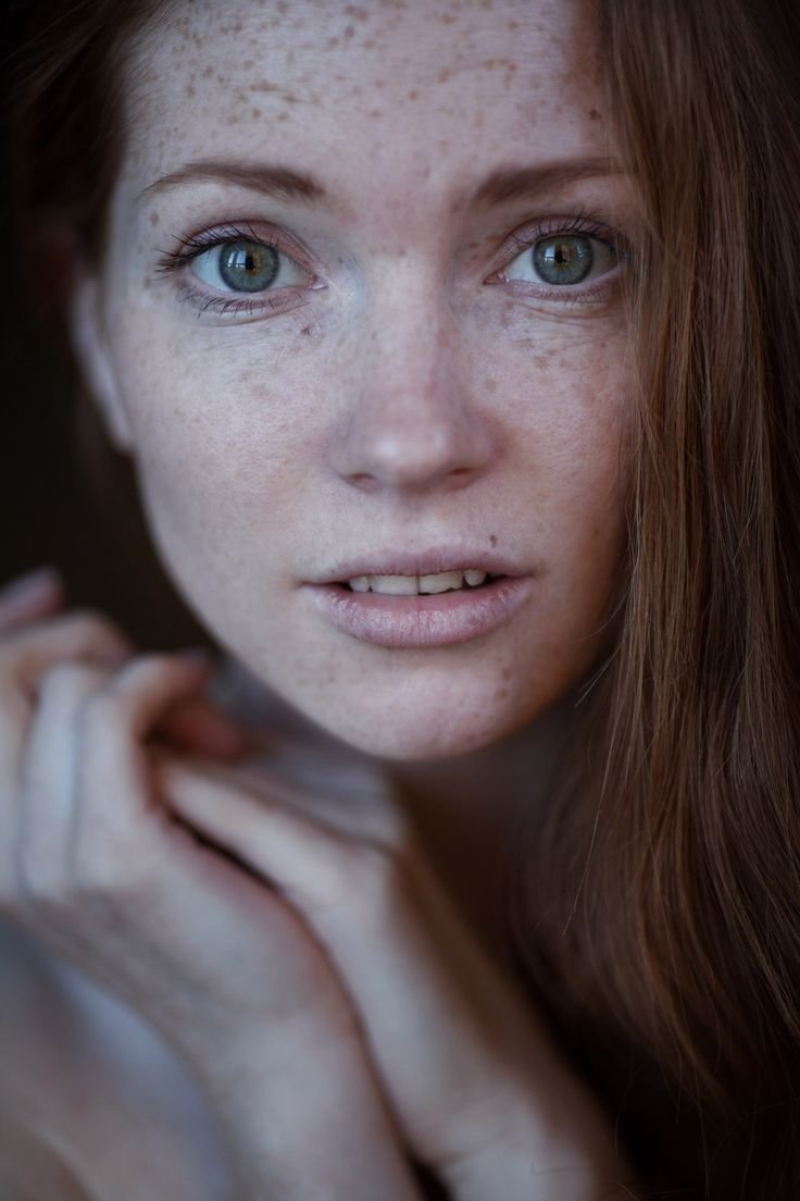 Ахметзянова веснушки