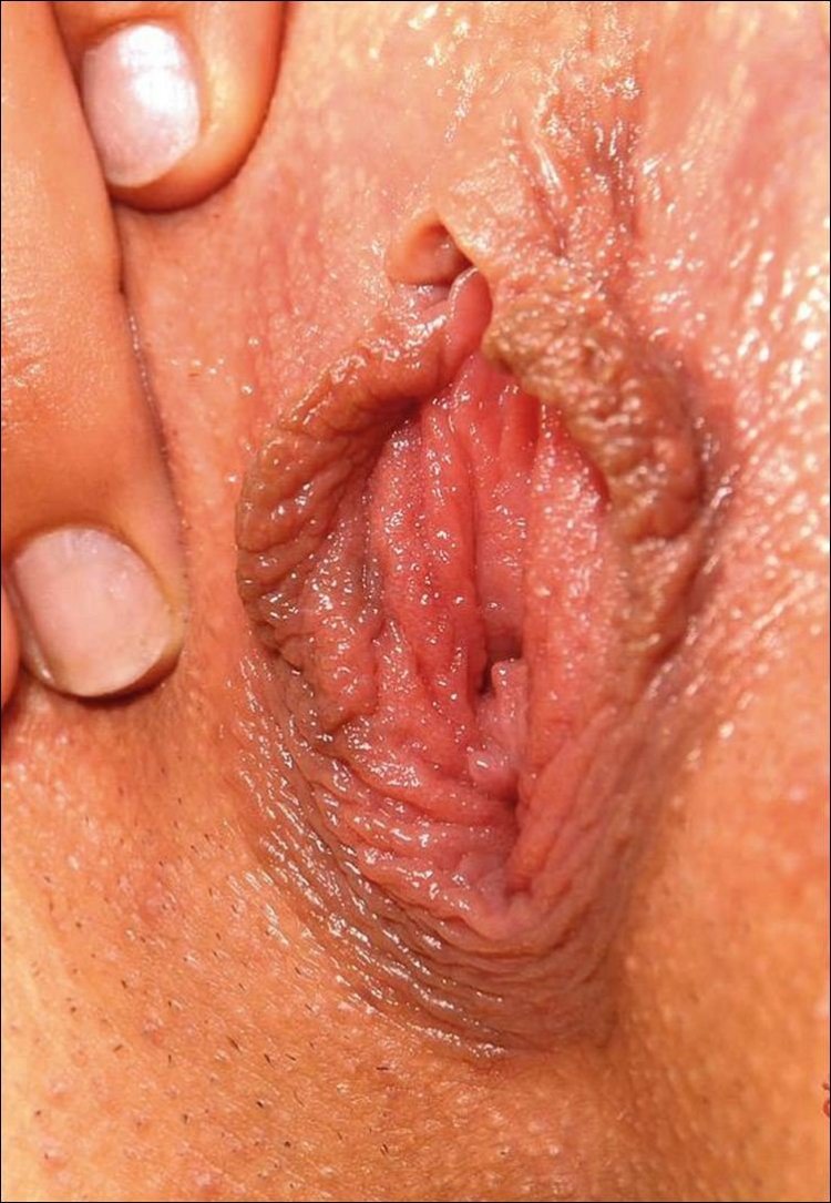 Воспаление бартолиновой железы