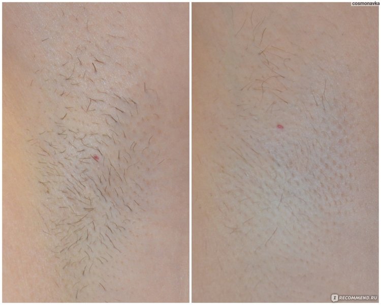 Лазерная депиляция эффект после первого раза