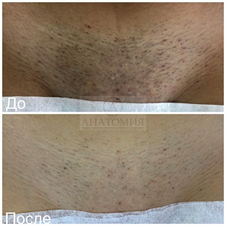 Восковая депиляция глубокое бикини