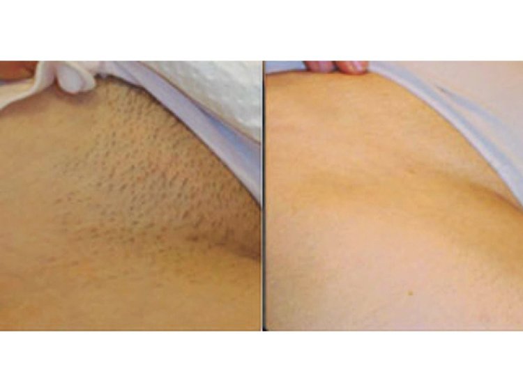 Бикини после лазерной эпиляции