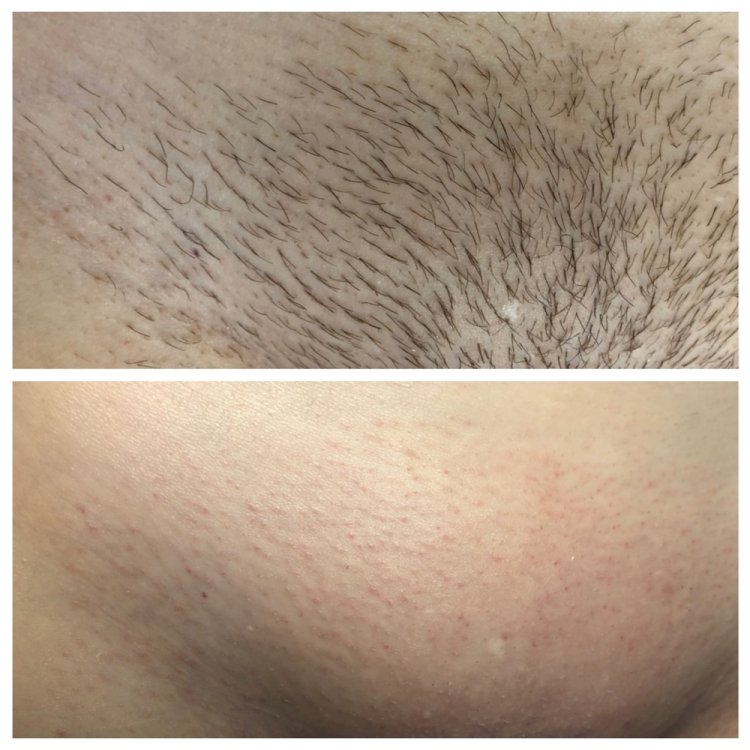 Позы для лазерной эпиляции