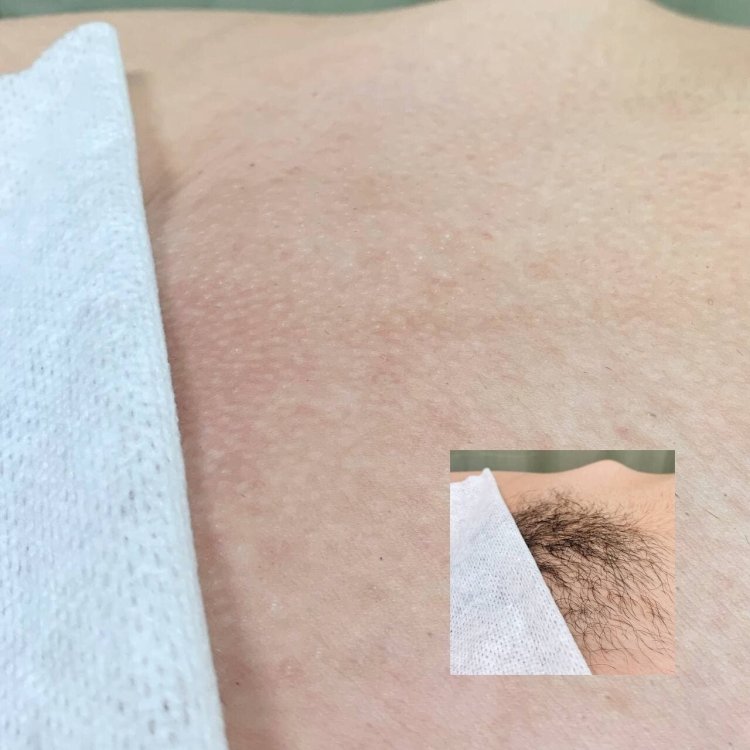 Бразильская депиляция