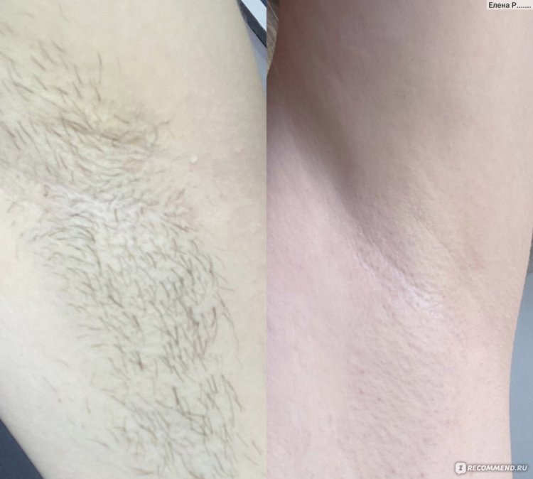 Эпиляция подмышек воском