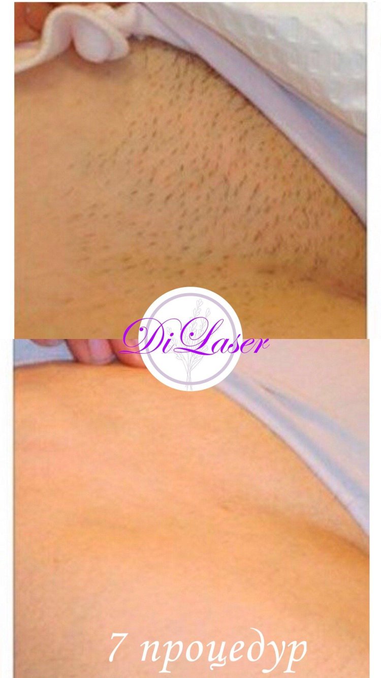 Эпиляция глубокого бикини лазером