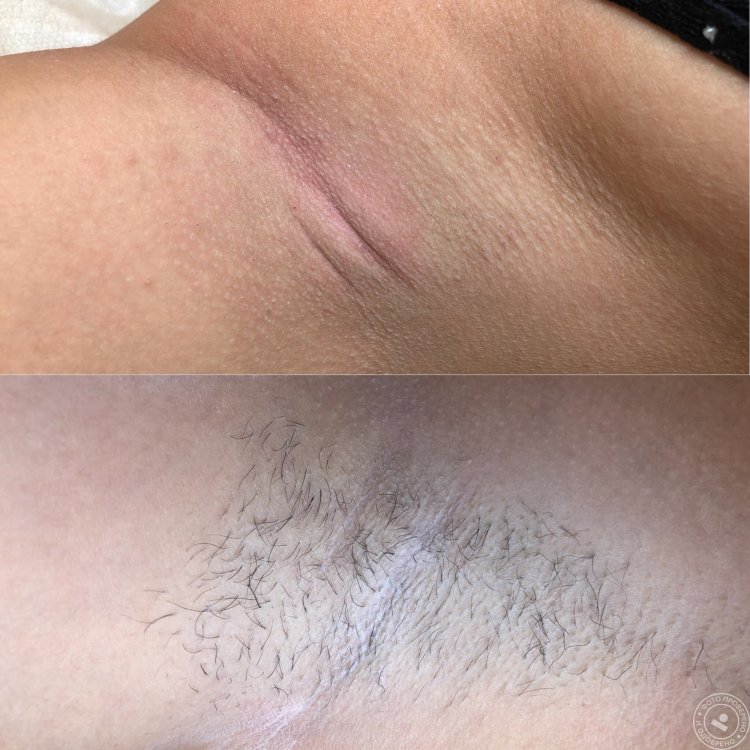 Электроэпиляция зоны глубокого бикини