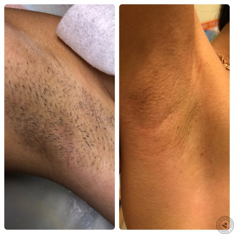 Волосы на ногах для шугаринга