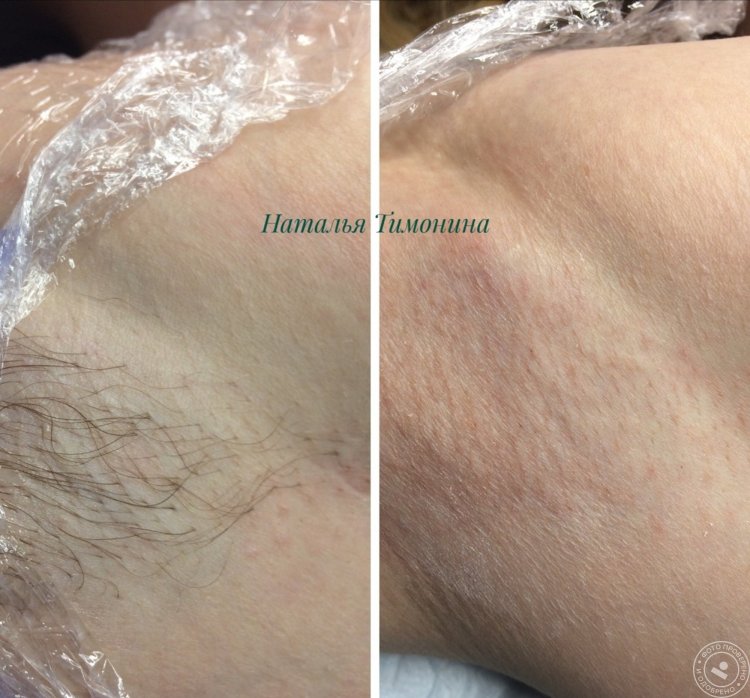 Электроэпиляция бикини