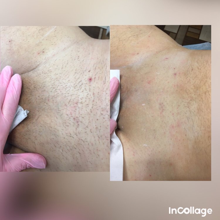 Депиляция воском подмышки