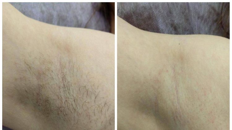 Мужчина и женщина эпиляция