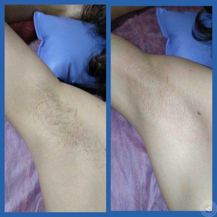 Первое бикини шугаринг