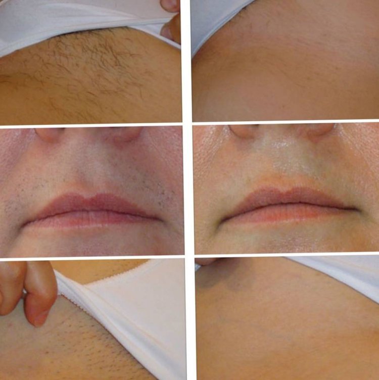 Афт лазерная эпиляция