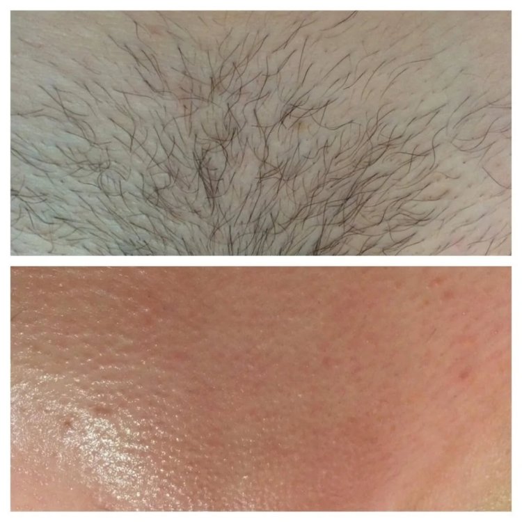 Электроэпиляция бикини глубокое