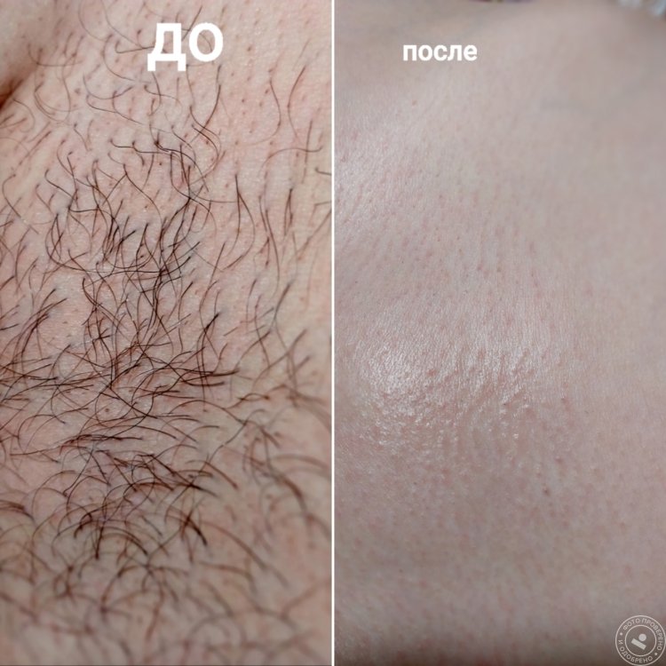 Эпиляция зоны бикини