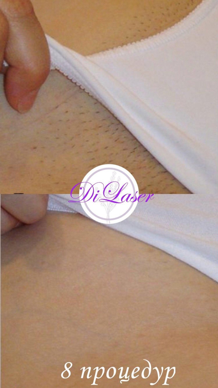 Лазерная эпиляция глубокого бикини