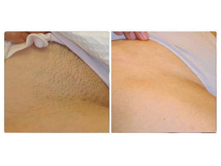 Лазерная депиляция бикини