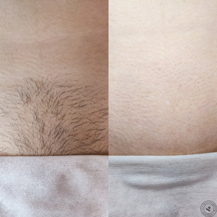 Элос эпиляция зона бикини