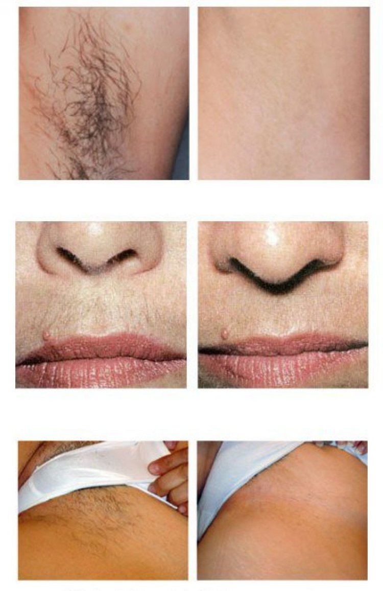 Фотоэпиляция глубокое бикини