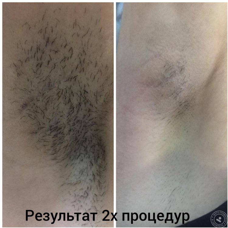 Лазерная эпиляция бикини