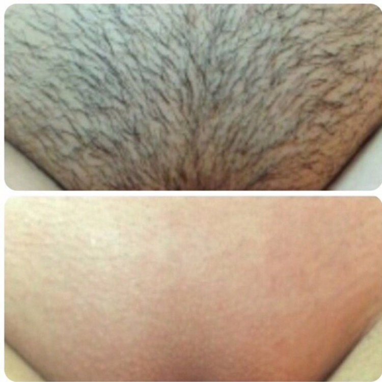 Депиляция глубокой зоны декольте