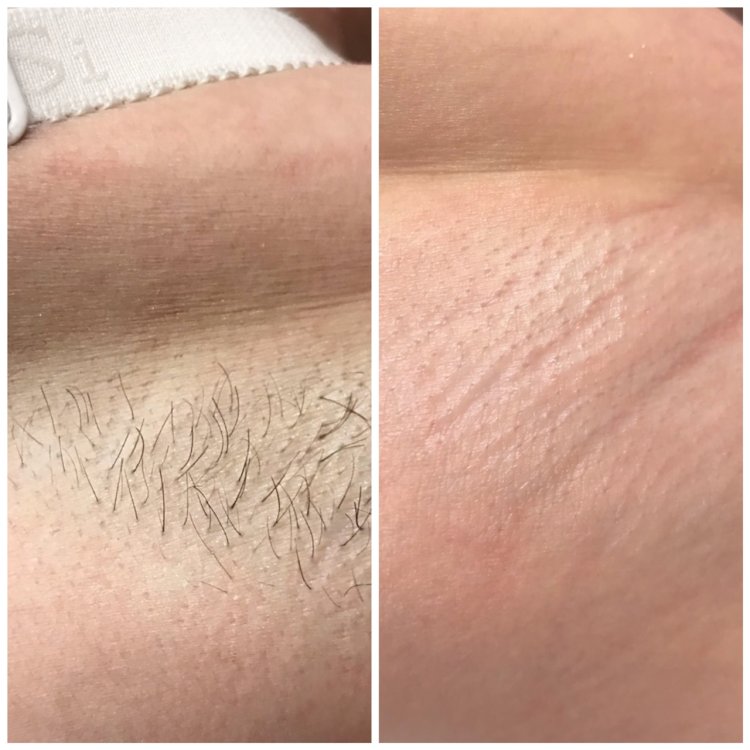 Лазерная эпиляция подмышки 1000 р