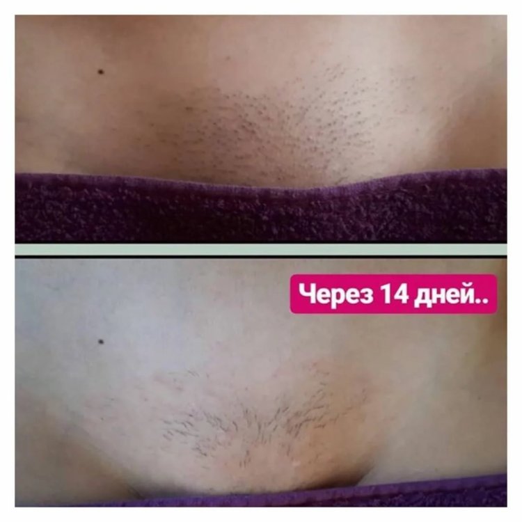 Выбритая зона бикини