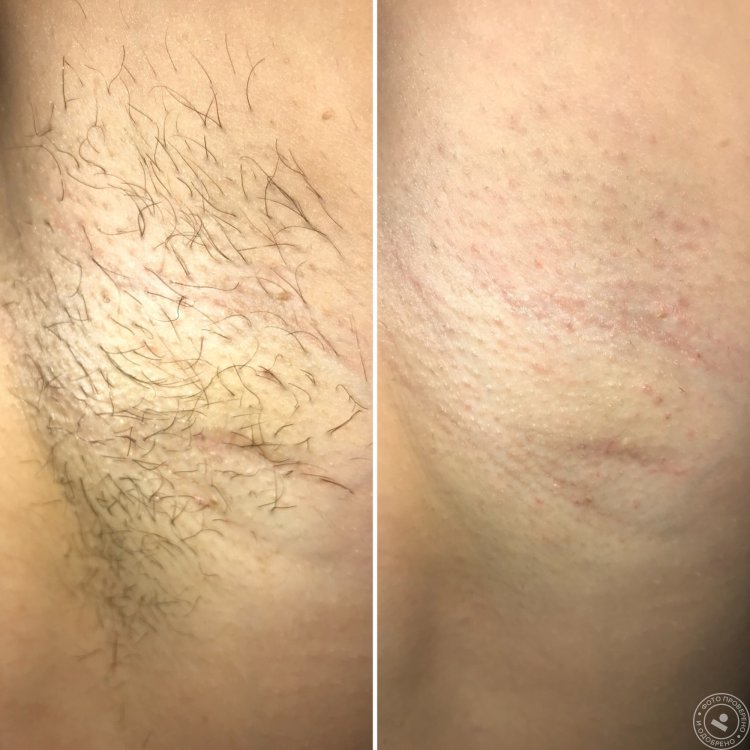 Депиляция Эстетика