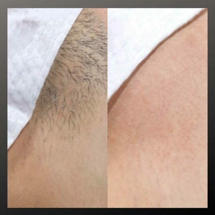 Эпиляция шугаринг