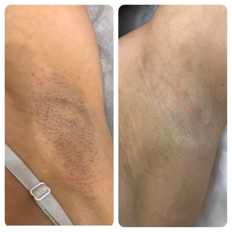 Солярий после шугаринга