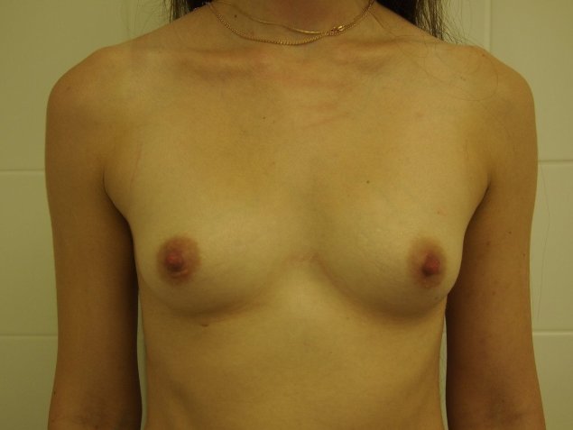 Килевидная деформация грудной клетки