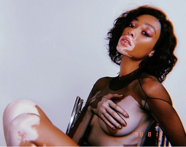 Голая негритянка с витилиго