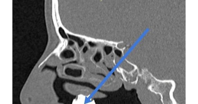 Остеома гайморовой пазухи на кт