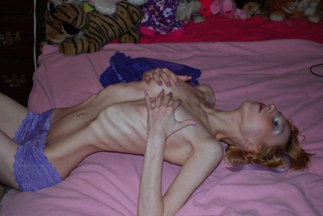 Голые женщины с анорексией