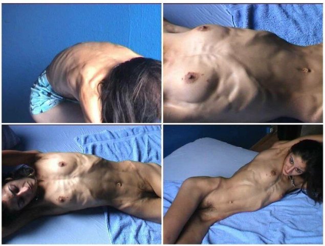 Голые женщины Анорексички