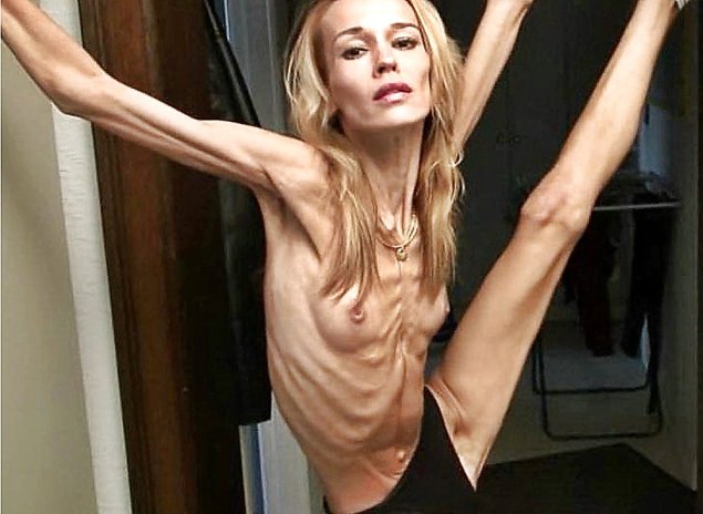 Анорексичные девушки ню