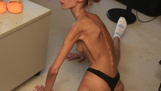 Голые тощие анорексички