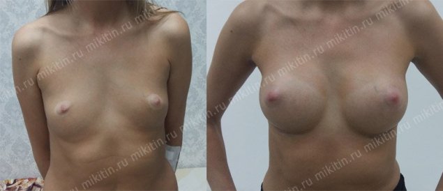 Фото груди с анатомическими имплантами