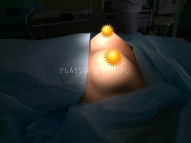 Светящиеся импланты грудные