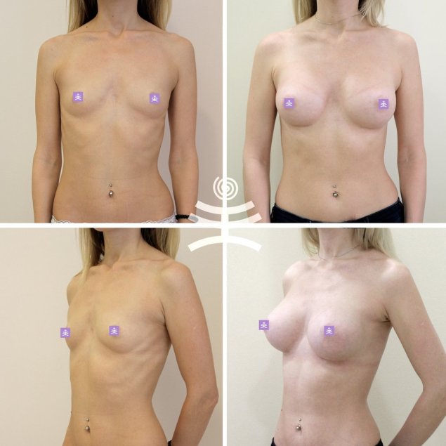 Силиконовая грудь Каплевидная