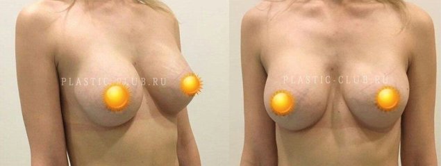 Увеличение груди