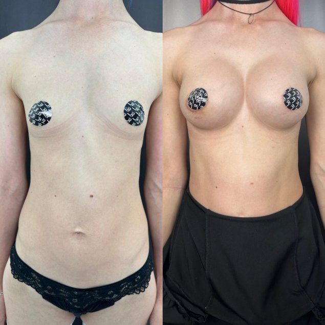 Сиськи с имплантами голые