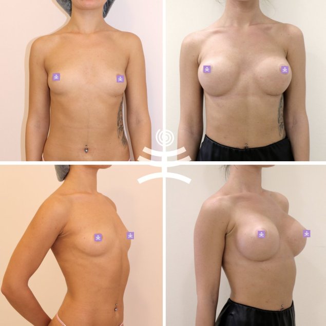 Круглые и анатомические импланты