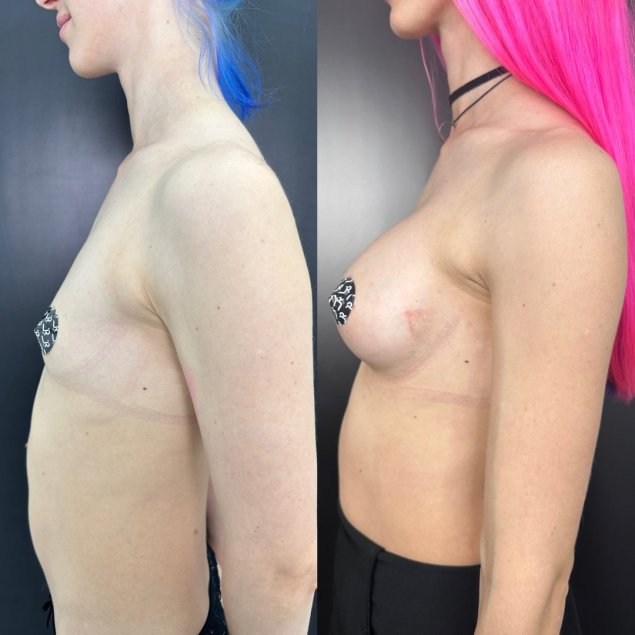 Коррекция груди до и после