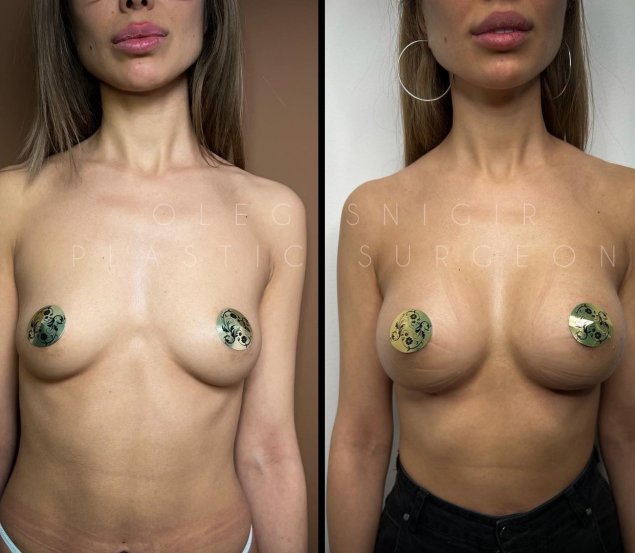 Юлия Снигирь пластические операции груди