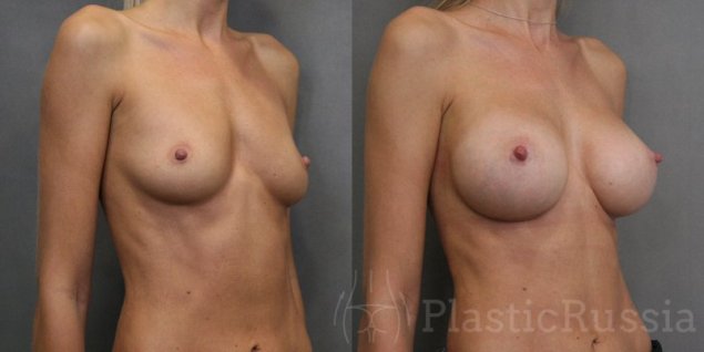 Голые женщины с имплантами