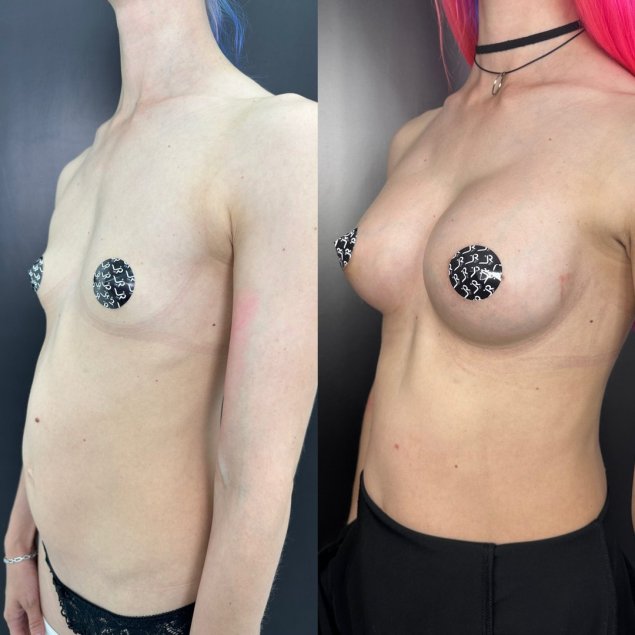 Сиськи с имплантами голые